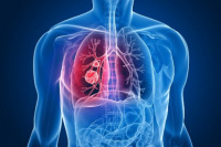 Entre el 10% y el 15% de las personas con cáncer de pulmón jamás fumaron
