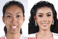 Tailandia: ganó un concurso y le operaron la cara