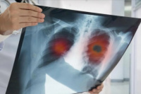 Aprobaron dos nuevas terapias para tratar el cáncer de pulmón y vejiga