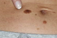 Alerta melanoma: mueren 10 personas por semana en el país