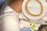 Una nena usó una bandita elástica en el brazo tanto tiempo que se le encarnó