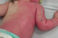Preocupación en Rawson: Un bebé de un año se quemó con agua hirviendo