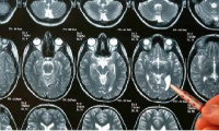 La enfermedad que padeció Gerardo Rozin: ¿Qué es un tumor cerebral?