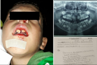 Tiene 7 años, sufrió un accidente doméstico y necesita $250.000 para una prótesis dental