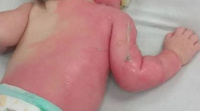 Un bebe de un año se quemó la cara y un brazo tras un accidente doméstico