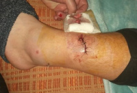 Otro ataque más: un nene de 11 años fue mordido por un pitbull y recibió 15 puntos de sutura 