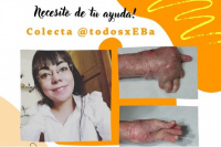 ¡TodosxEBa!: Bingo y baile solidario para ayudar a Evangelina, una joven que padece piel de mariposa