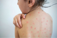 Se confirmó un caso de sarampión y desde el Gobierno alertan por la baja vacunación
